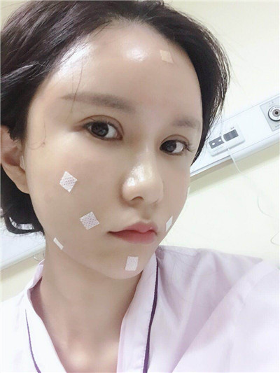 杭州维多利亚马腾面部填充怎么样?好不好?案例分享