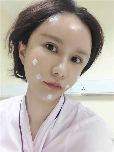 杭州维多利亚马腾面部填充怎么样?好不好?案例分享