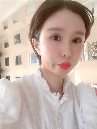 杭州维多利亚马腾面部填充怎么样?好不好?案例分享