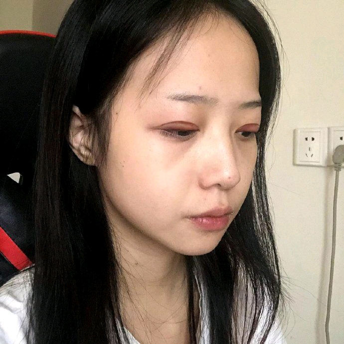 台州博雅美惠王大明切开双眼皮怎么样?好不好?案例分享