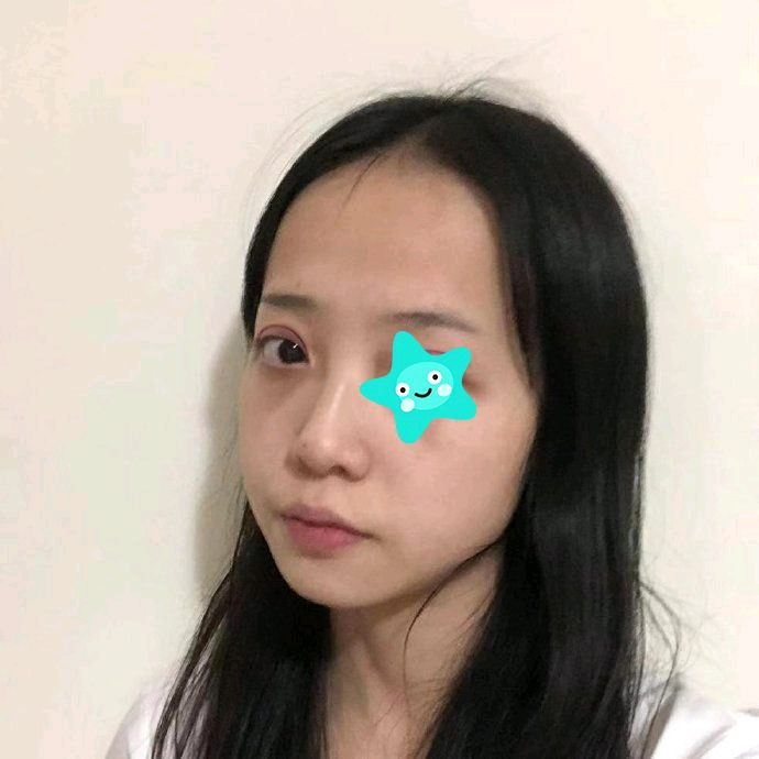 台州博雅美惠王大明切开双眼皮怎么样?好不好?案例分享