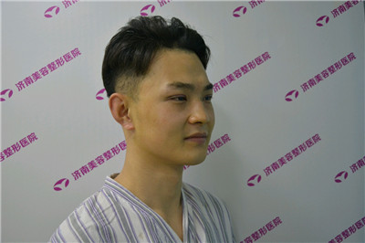 济南美容张大勇眼部手术怎么样?好不好?案例分享