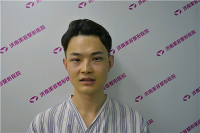 济南美容张大勇眼部手术怎么样?好不好?案例分享