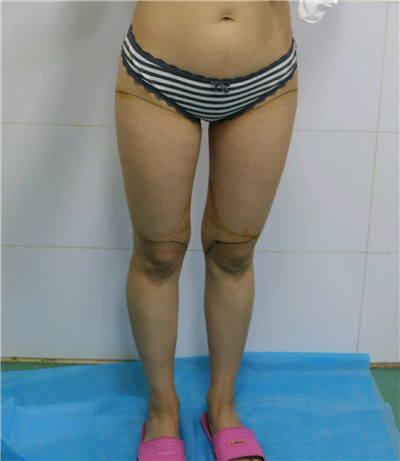 北京金燕子马铁安吸脂瘦大腿怎么样?好不好?案例分享