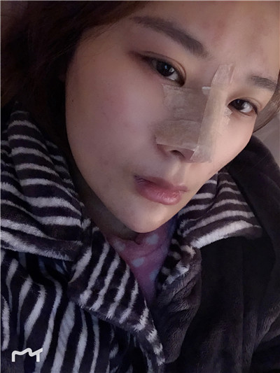 兰州崔大夫徐陇豫耳软骨隆鼻怎么样?好不好?案例分享