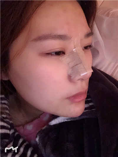 兰州崔大夫徐陇豫耳软骨隆鼻怎么样?好不好?案例分享