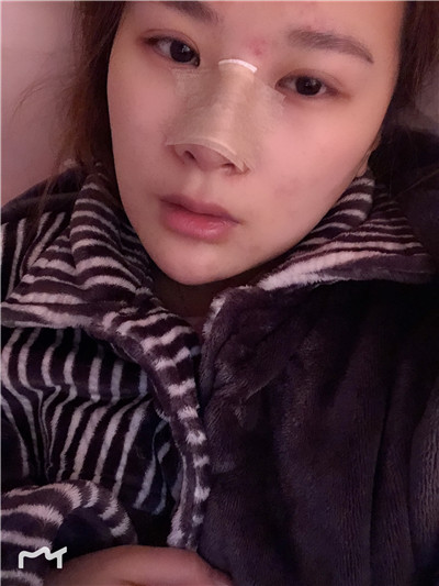 兰州崔大夫徐陇豫耳软骨隆鼻怎么样?好不好?案例分享