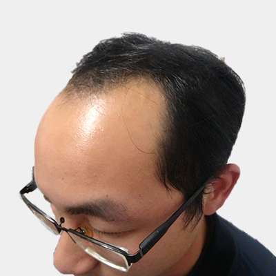 武汉仁爱王海峰种植发际线怎么样?好不好?案例分享