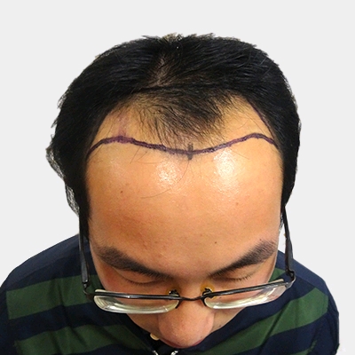 武汉仁爱王海峰种植发际线怎么样?好不好?案例分享
