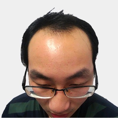 武汉仁爱王海峰种植发际线怎么样?好不好?案例分享