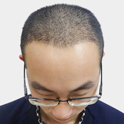 武汉仁爱王海峰种植发际线怎么样?好不好?案例分享