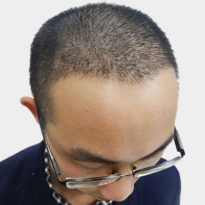 武汉仁爱王海峰种植发际线怎么样?好不好?案例分享