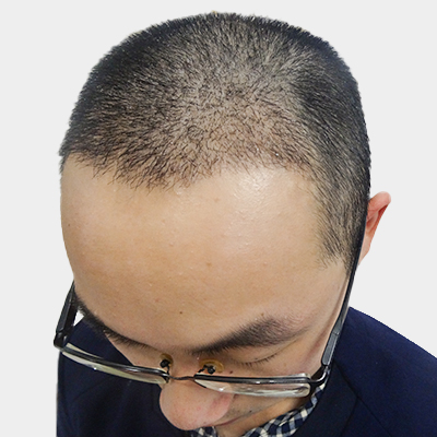 武汉仁爱王海峰种植发际线怎么样?好不好?案例分享