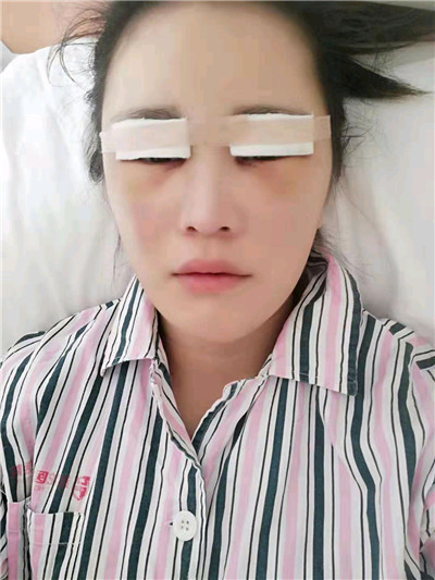 黑龙江超龙吴显宇切开双眼皮怎么样?好不好?案例分享
