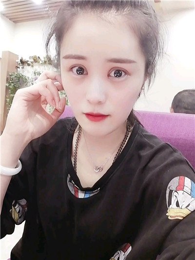 黑龙江超龙吴显宇切开双眼皮怎么样?好不好?案例分享