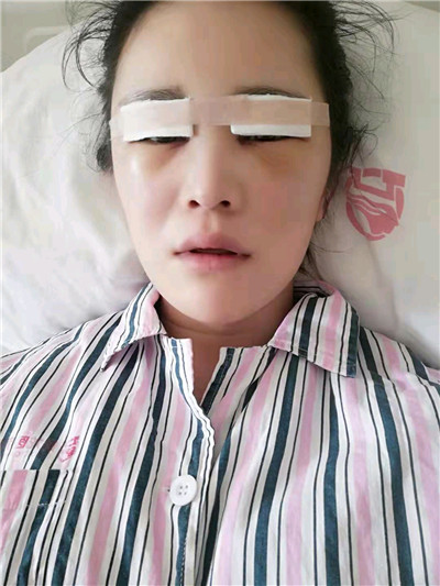 黑龙江超龙吴显宇切开双眼皮怎么样?好不好?案例分享