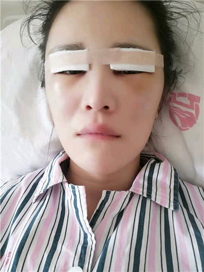 黑龙江超龙吴显宇切开双眼皮怎么样?好不好?案例分享
