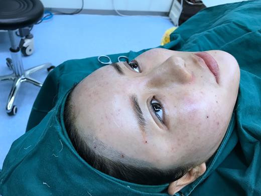 太原美媛荟弓军胜脂肪填充怎么样?价格案例分享