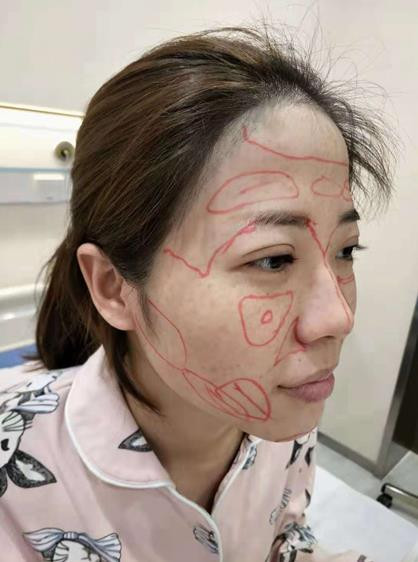 太原美媛荟弓军胜脂肪填充怎么样?价格案例分享