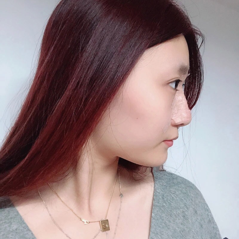 广州荔医张勇鼻部手术怎么样?价格案例分享