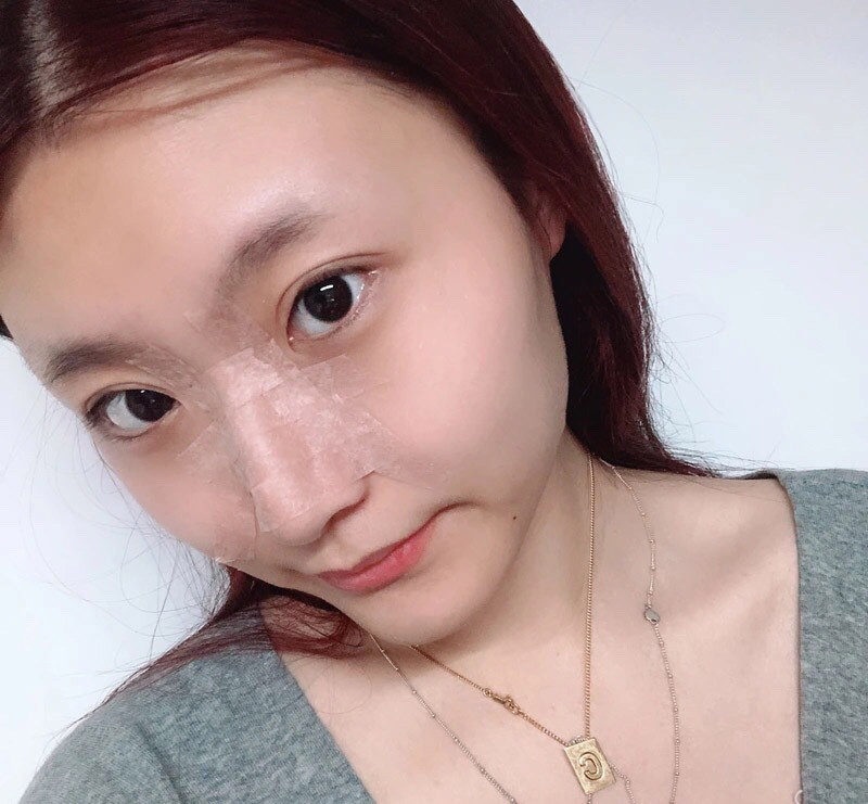 广州荔医张勇鼻部手术怎么样?价格案例分享