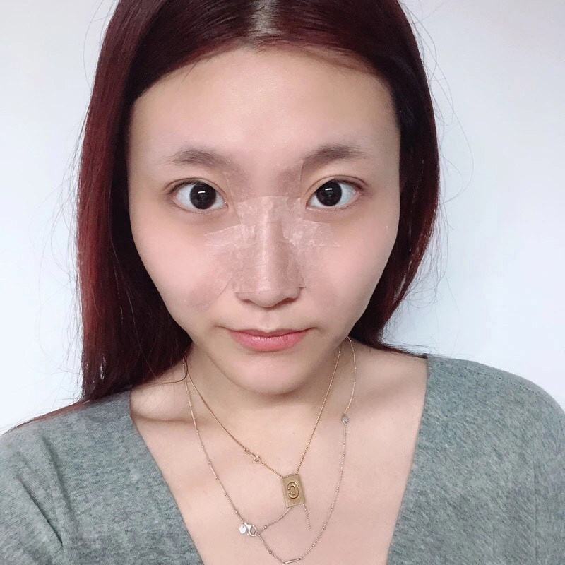 广州荔医张勇鼻部手术怎么样?价格案例分享