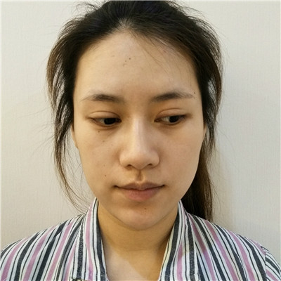 杭州西美赵晓阳面部吸脂怎么样?价格案例分享