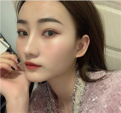 西安第二附属肖潮切开双眼皮怎么样?价格案例分享