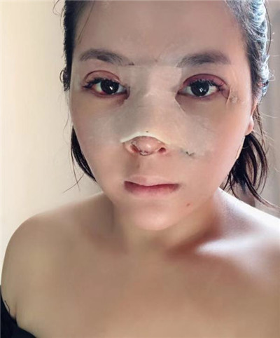 太原丽都杨顺新鼻部手术怎么样?价格案例分享