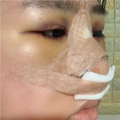 普瑞美硅胶隆鼻怎么样?价格案例分享