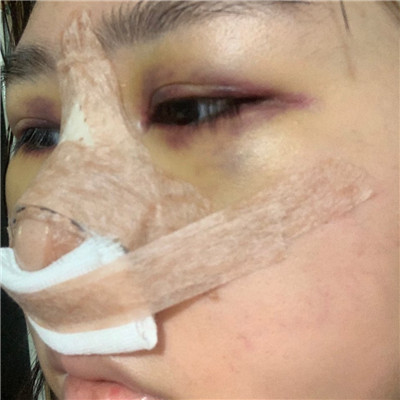 普瑞美硅胶隆鼻怎么样?价格案例分享