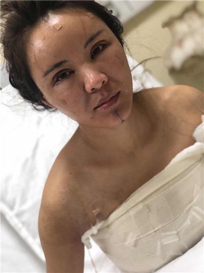 杭州维多利亚刘中策怎么样?价格案例分享