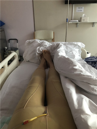 袁玉坤吸脂瘦大腿怎么样?价格案例分享