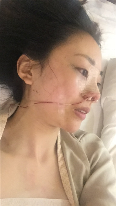 成都艺星黄文肋软骨隆鼻怎么样?价格案例分享