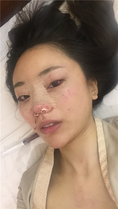 成都艺星黄文肋软骨隆鼻怎么样?价格案例分享