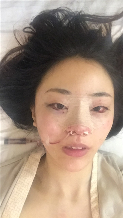 成都艺星黄文肋软骨隆鼻怎么样?价格案例分享
