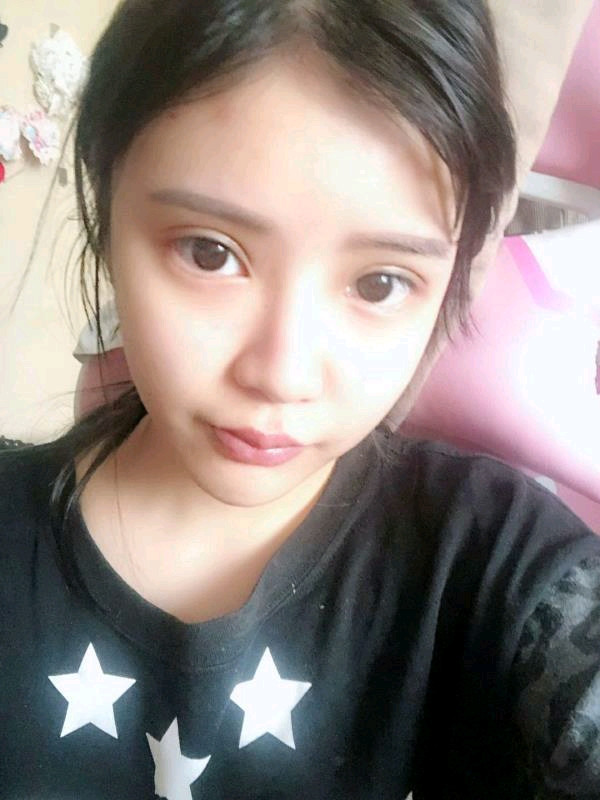 合肥壹加壹医院孟松眼部手术怎么样?价格案例