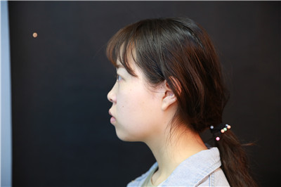 长沙美莱邹俊峰鼻部手术怎么样?价格案例分享