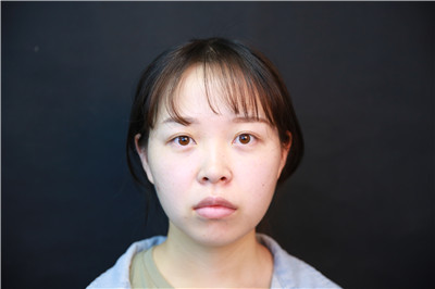 长沙美莱邹俊峰鼻部手术怎么样?价格案例分享