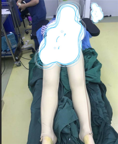 杭州港丽曹飞超吸脂瘦腹部怎么样?价格案例分享