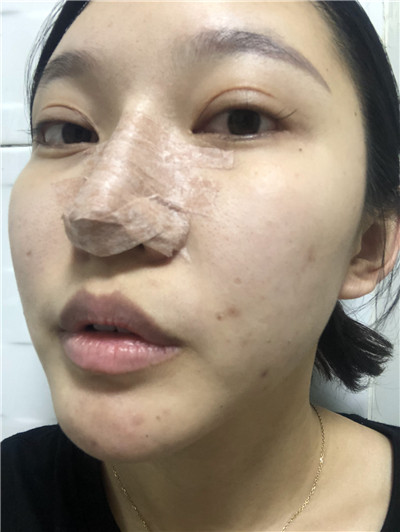 武汉艺星杨国梁鼻部手术怎么样?价格案例分享
