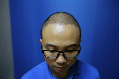 南宁贞韩尹炜能种植发际线怎么样?价格案例分享