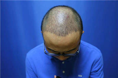 南宁贞韩尹炜能种植发际线怎么样?价格案例分享