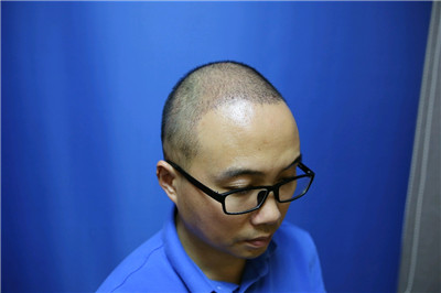 南宁贞韩尹炜能种植发际线怎么样?价格案例分享