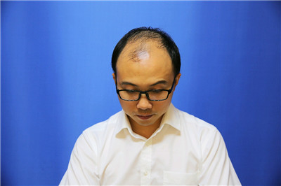 南宁贞韩尹炜能种植发际线怎么样?价格案例分享