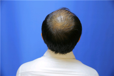 南宁贞韩尹炜能种植发际线怎么样?价格案例分享