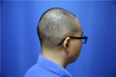 南宁贞韩尹炜能种植发际线怎么样?价格案例分享