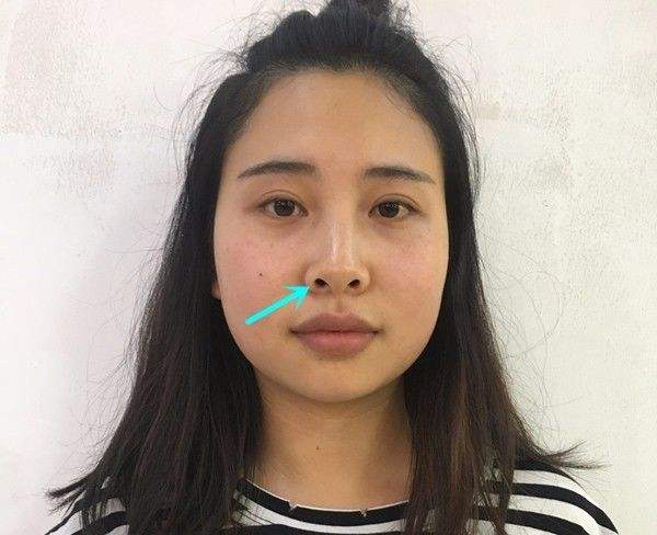 什么是朝天鼻?怎么改善?