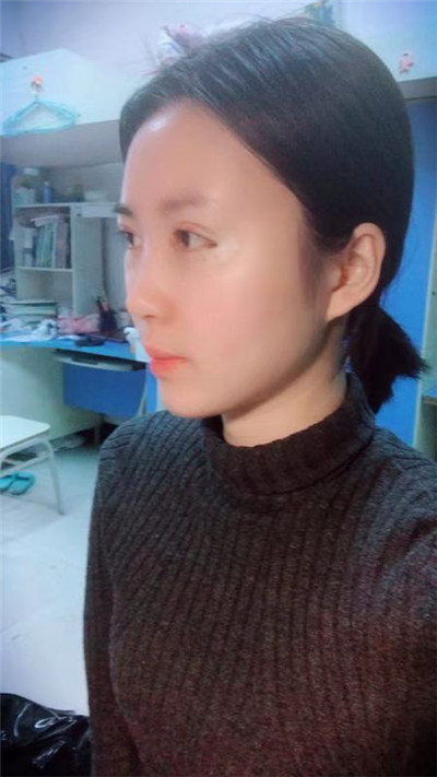 蚌埠美莱坞张迪眼部综合怎么样?价格案例分享