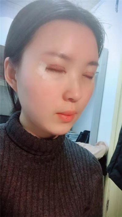 蚌埠美莱坞张迪眼部综合怎么样?价格案例分享